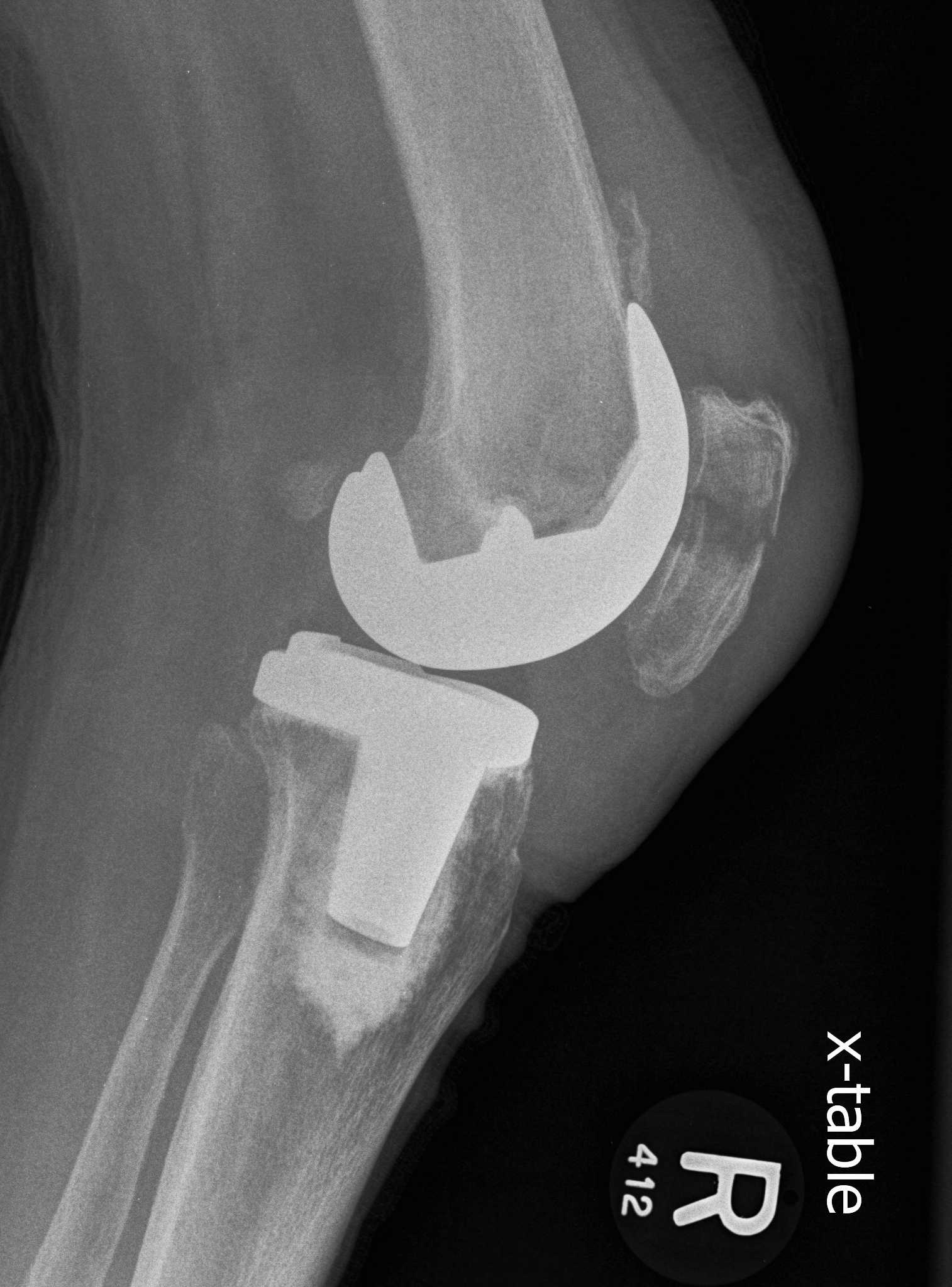 TKR Patella Fracture